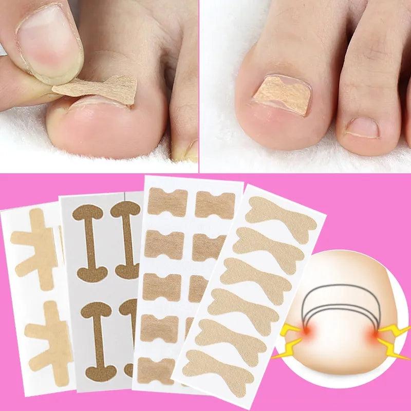 Ingrown Toenail Correction: Stickers Glue Toenail Corrector Patches