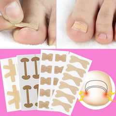Ingrown Toenail Correction: Stickers Glue Toenail Corrector Patches