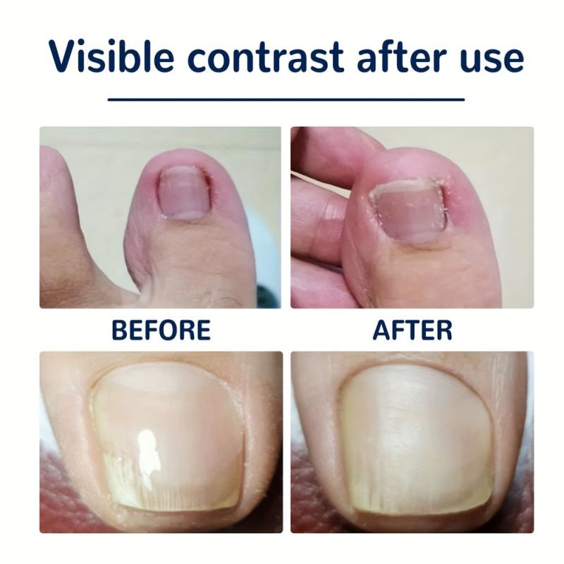 Ingrown Toenail Correction Stickers Nail Corrector Patches