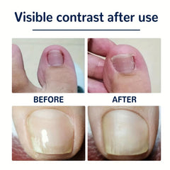 Ingrown Toenail Correction Stickers Nail Corrector Patches