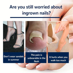 Ingrown Toenail Correction Stickers Nail Corrector Patches
