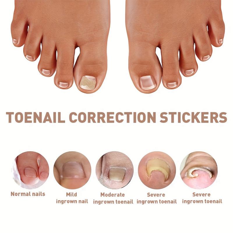 50 Pcs Ingrown Toenail Corrector Patch With File And Lifter