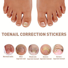 50 Pcs Ingrown Toenail Corrector Patch With File And Lifter