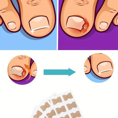 50 Pcs Ingrown Toenail Corrector Patch With File And Lifter