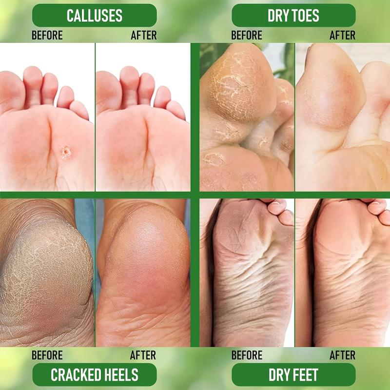 Lemongrass Foot Cream Tea Tree Peppermint Moisturizer Dry Feet