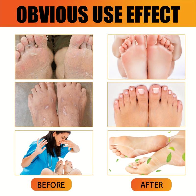 Athlete's Foot Cream for Dry Cracked Skin