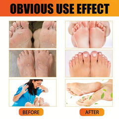 Athlete's Foot Cream for Dry Cracked Skin