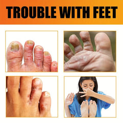Athlete's Foot Cream for Dry Cracked Skin