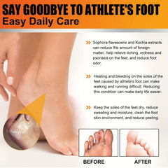 Athlete's Foot Cream for Dry Cracked Skin