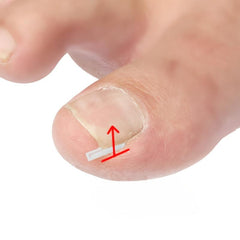 20pcs Ingrown Toenail Corrector Strips Brace Pedicure Tool