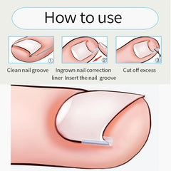 20pcs Ingrown Toenail Corrector Strips Brace Pedicure Tool