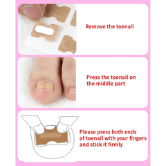 40PCS Ingrown Toenail Correction Strips Nail Care Tool