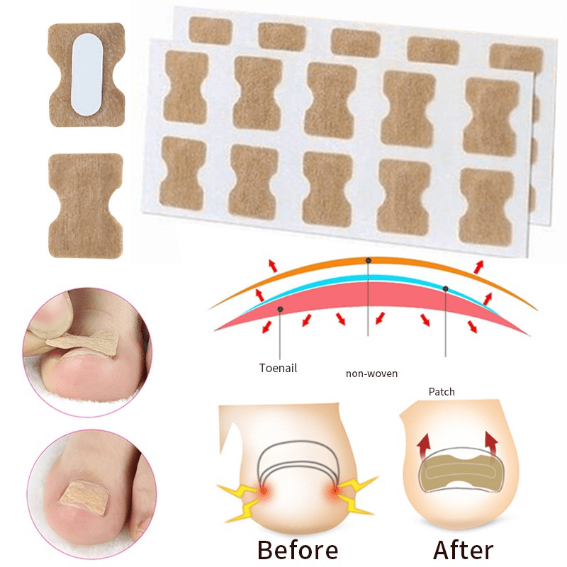 40PCS Ingrown Toenail Correction Strips Nail Care Tool