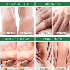 Tea Tree Foot Cream for Dry Rough Skin Repair