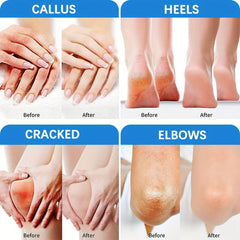 Urea Cream 40 Plus Salicylic Acid 2 Foot Cream For Dry Cracked Feet