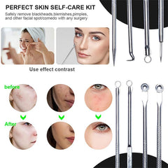 Professional Blackhead Remover Needle for Clearer Skin