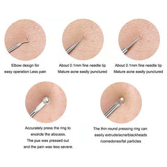Professional Blackhead Remover Needle for Clearer Skin