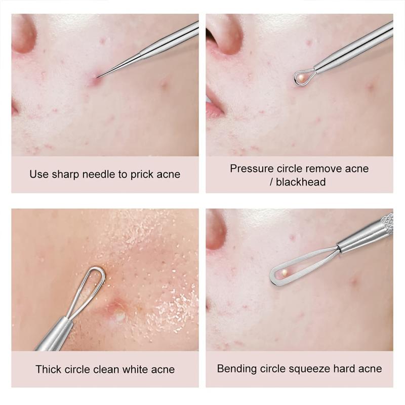 5pcs Pimple Popping Kit Stainless Steel Acne Clips & Beauty Needles