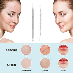 5pcs Pimple Popping Kit Stainless Steel Acne Clips & Beauty Needles