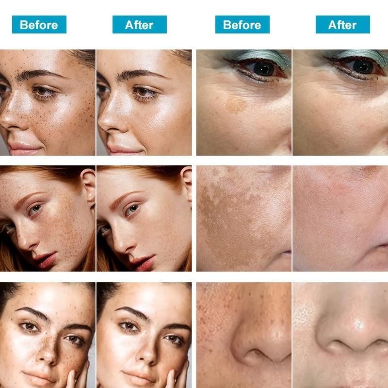 Dark Spot Remover for Face & Body - Melasma Freckle Sun Spot & Blemish Reducer