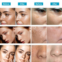 Dark Spot Remover for Face & Body - Melasma Freckle Sun Spot & Blemish Reducer