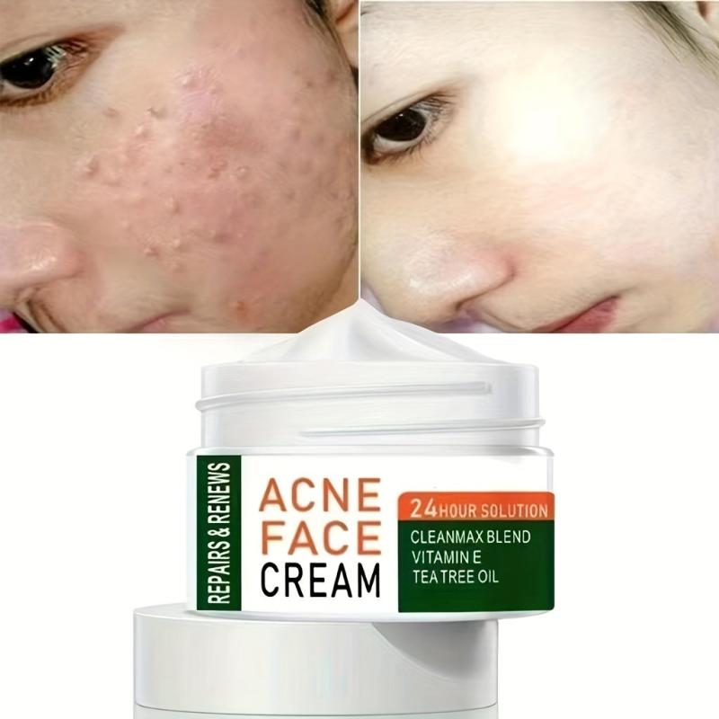 Herbal Tea Tree Face Cream for Acne Marks & Pits Fade