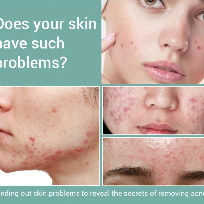 Herbotany Acne Pimple Salicylic Acid Fade Spot Treatment