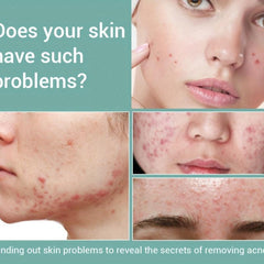 Herbotany Acne Pimple Salicylic Acid Fade Spot Treatment