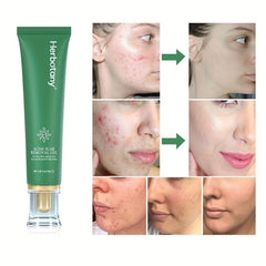 Herbotany Acne Pimple Salicylic Acid Fade Spot Treatment