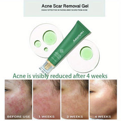 Herbotany Acne Pimple Salicylic Acid Fade Spot Treatment