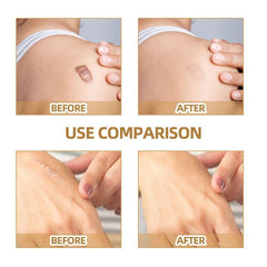 Invisible Concealer Patch Waterproof Skin Tone Cover Up Sticker