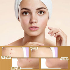 Invisible Concealer Patch Waterproof Skin Tone Cover Up Sticker