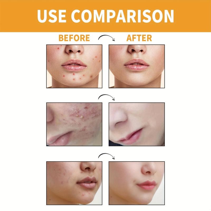 Invisible Acne Concealer Stickers 10 Patches Box
