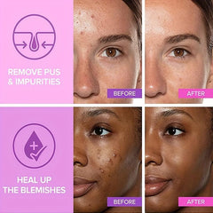 36 Pcs Acne Patch Pimple Patch Acne Spot Dots Patch Blemish Spot Stickers