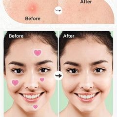 Heart Acne Pimple Patch - Invisible Spot Sticker