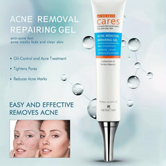 Hydrating Acne Removal Cream for Clear Skin