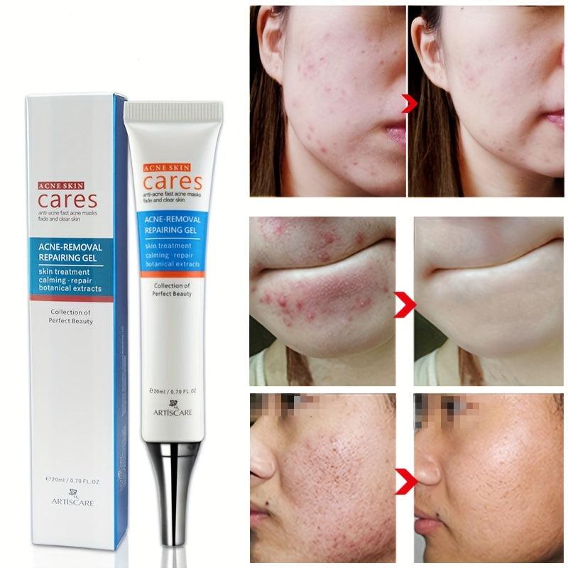 Hydrating Acne Removal Cream for Clear Skin