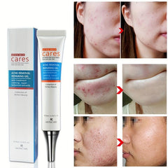 Hydrating Acne Removal Cream for Clear Skin
