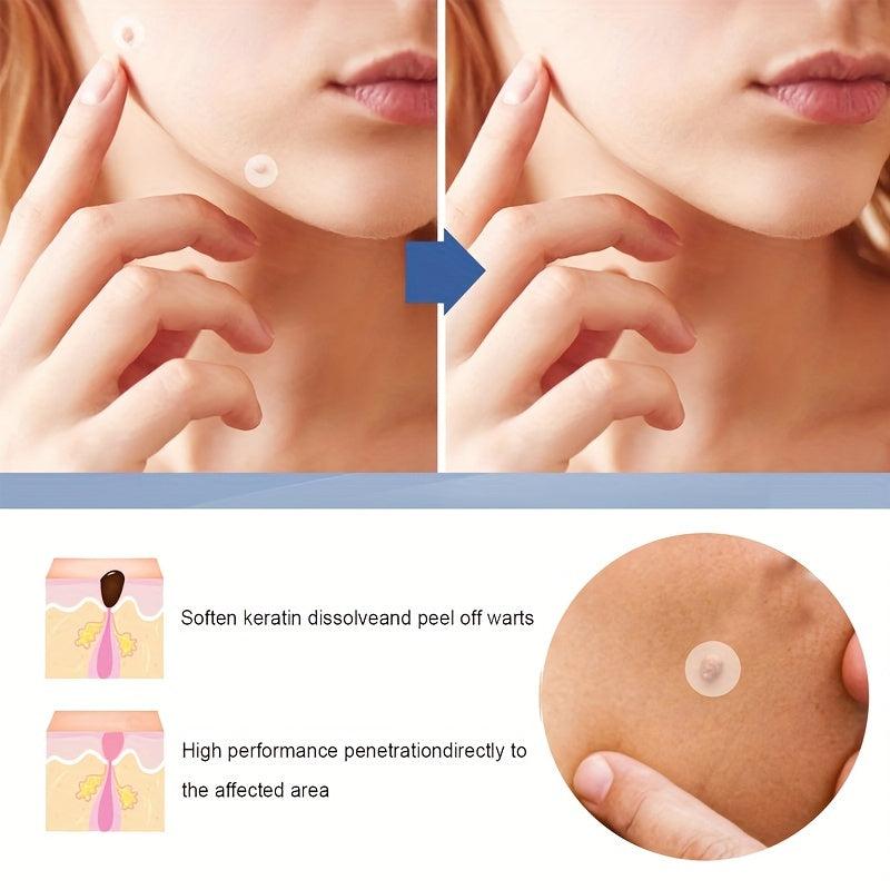 Hydrocolloid Acne Pimple Patches - Cover Pimples & Blemishes