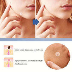 Hydrocolloid Acne Pimple Patches - Cover Pimples & Blemishes