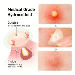 Acne Pimple Patch for Zits Blemishes Spot Stickers Face Skin