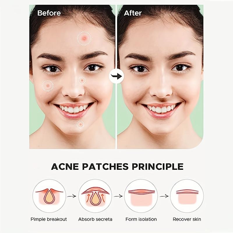Hydrocolloid Acne Patches - Cover Zits and Blemishes
