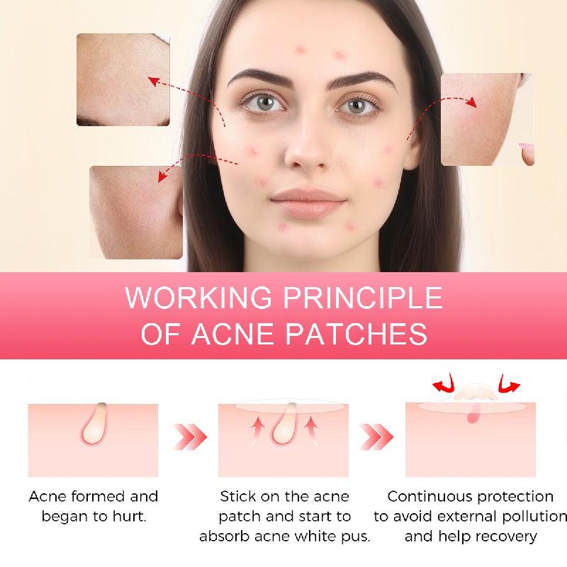 360pcs Hydrogel Acne Patch Label Cover Patch