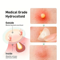Hydrocolloid Acne Pimple Patch for Clear Skin