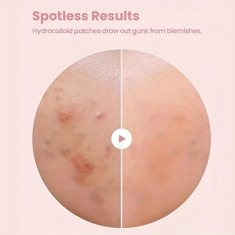 Hydrocolloid Acne Pimple Patch for Clear Skin