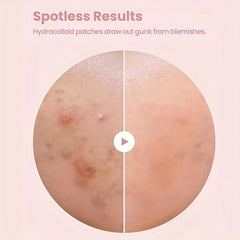 Hydrocolloid Acne Pimple Patch for Clear Skin