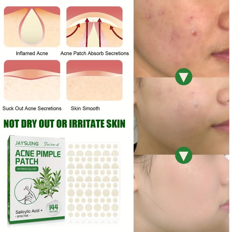 Tea Tree Acne Pimple Patches Hydrocolloid Waterproof Spot Stickers