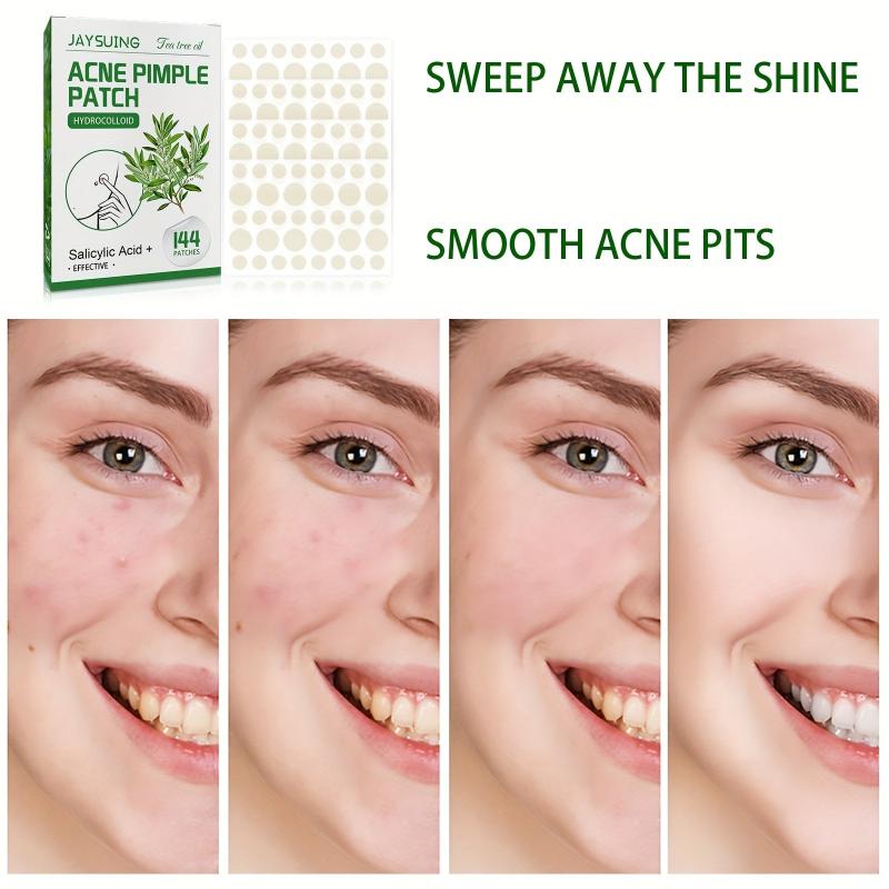 Tea Tree Acne Pimple Patches Hydrocolloid Waterproof Spot Stickers