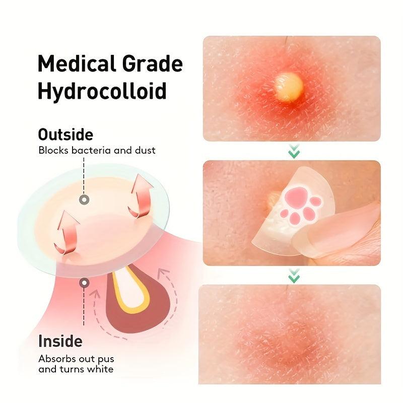 Hydrocolloid Acne Pimple Patch Tea Tree Facial Sticker