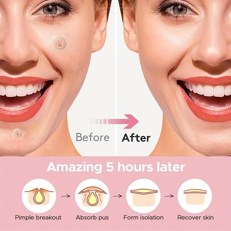 Hydrocolloid Acne Pimple Patch Tea Tree Facial Sticker